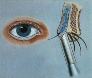 Imagen representativa del tratamiento de la distiquiasis congénita