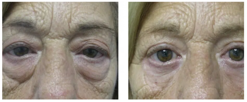 Blefaroplastia 1