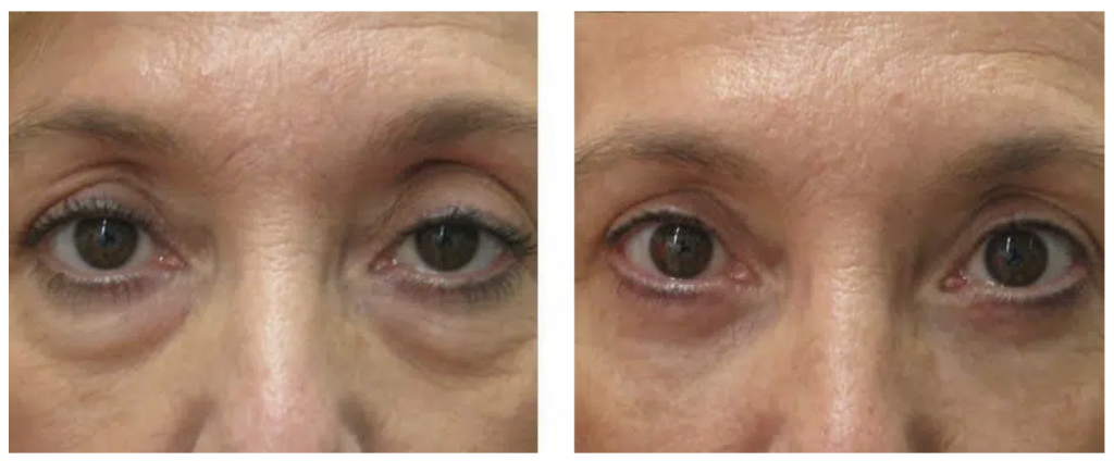Blefaroplastia 2