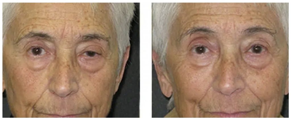 Blefaroplastia 4