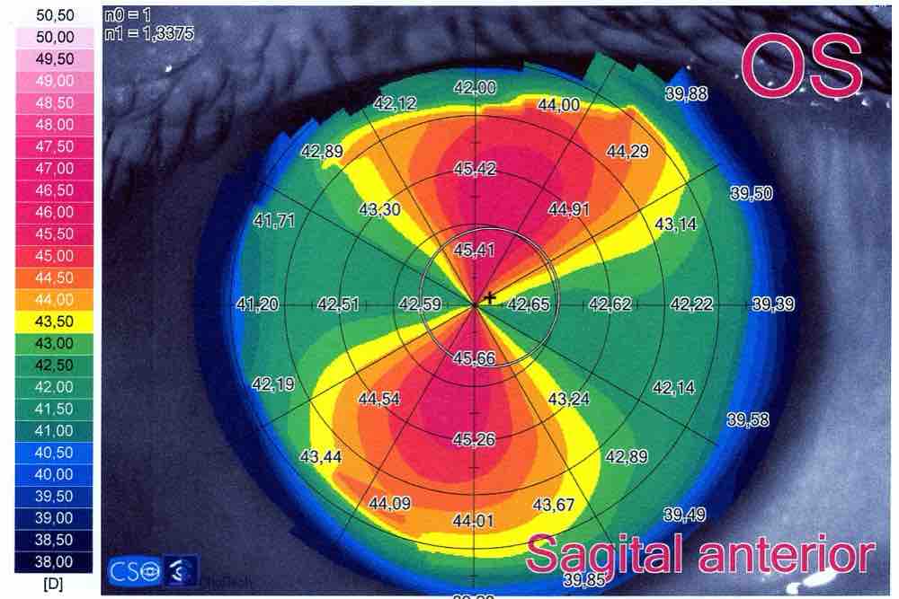 Topografía de la cornea