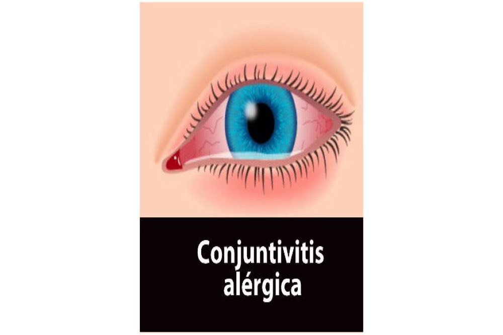 Conjuntivitis alergica