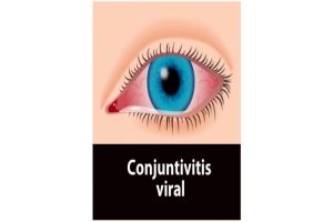 Conjuntivitis vírica