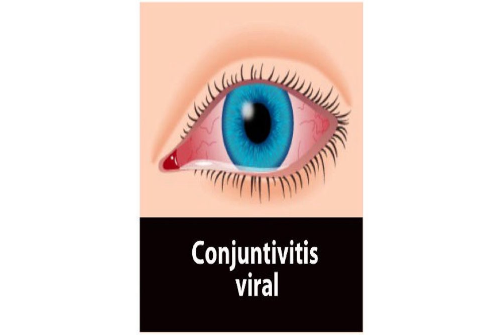 Conjuntivitis viral
