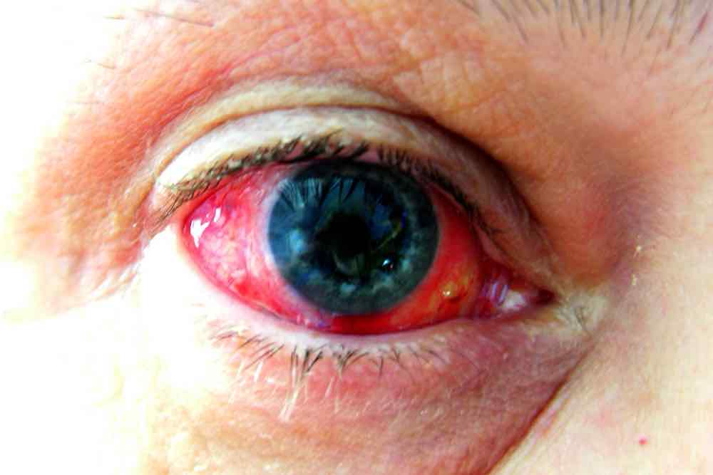 Enfermedad ojo rojo