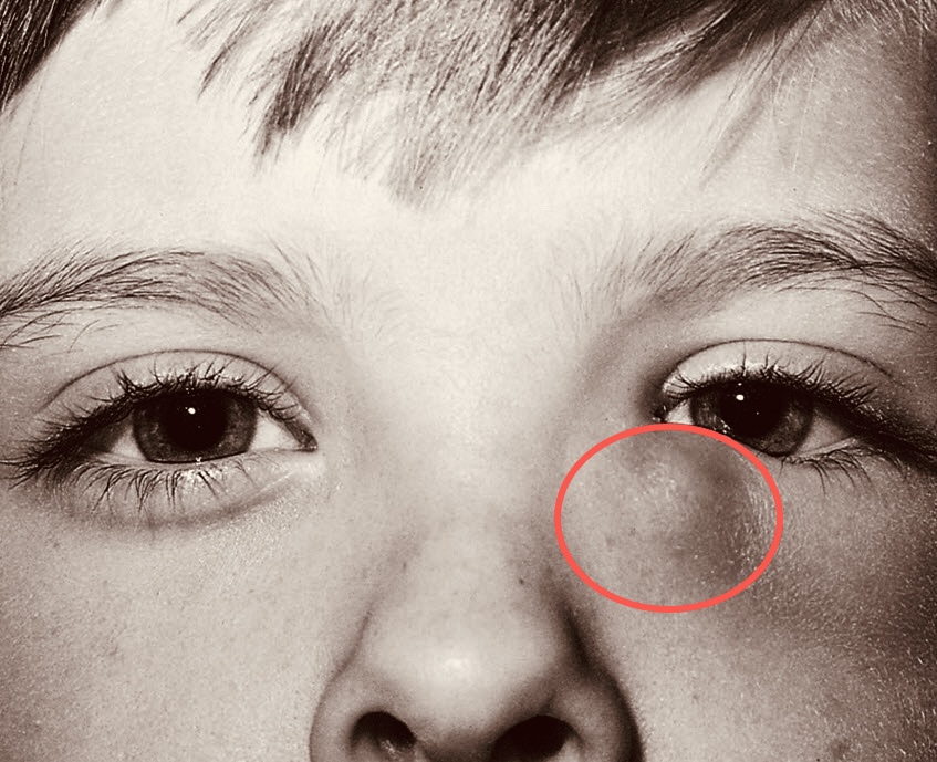 Imagen dacriocistitis en un niño