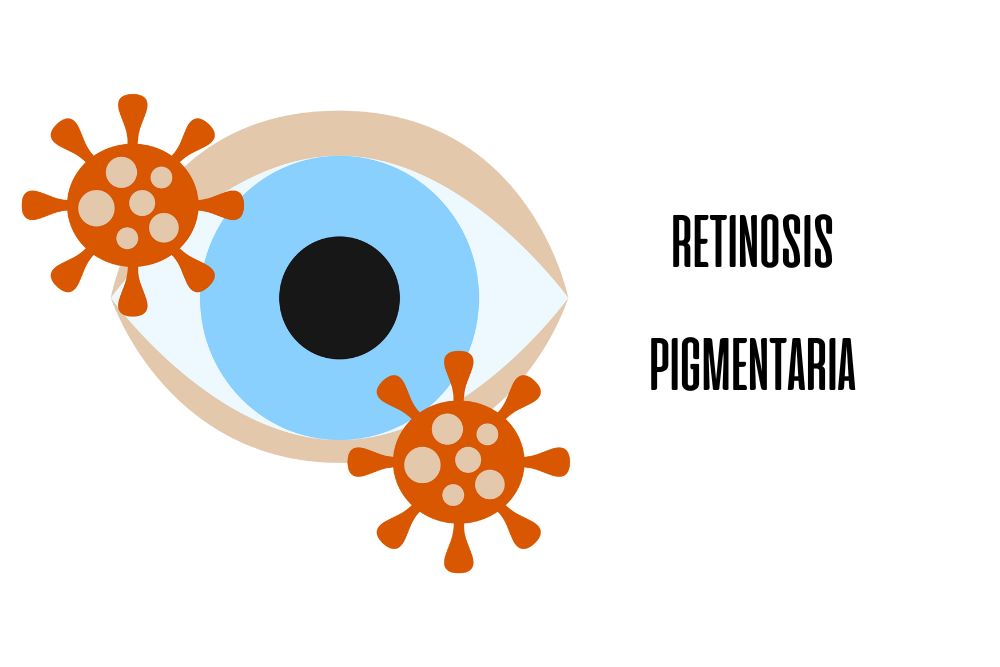 Retinosis pigmentaria / Ojopedia