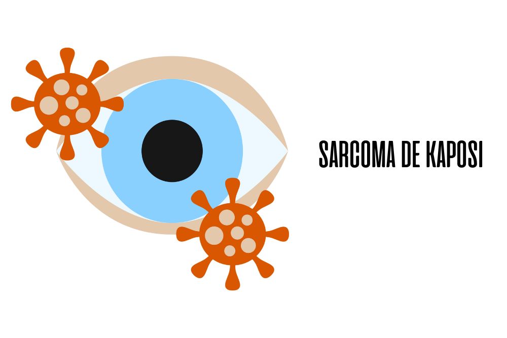 Sarcoma de kaposi / Ojopedia