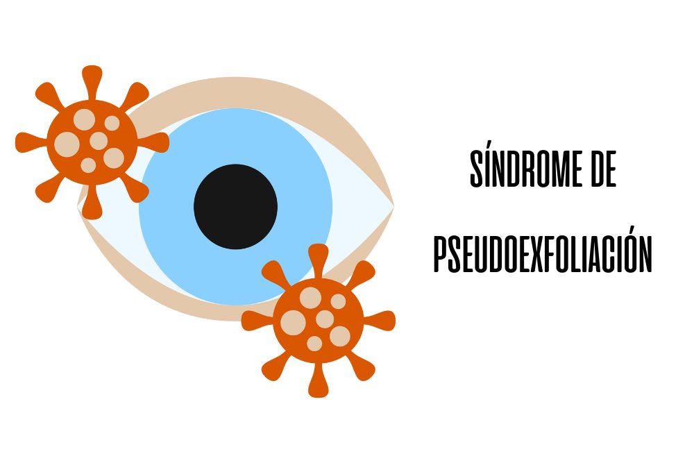 Síndrome de pseudoexfoliacion / Ojopedia