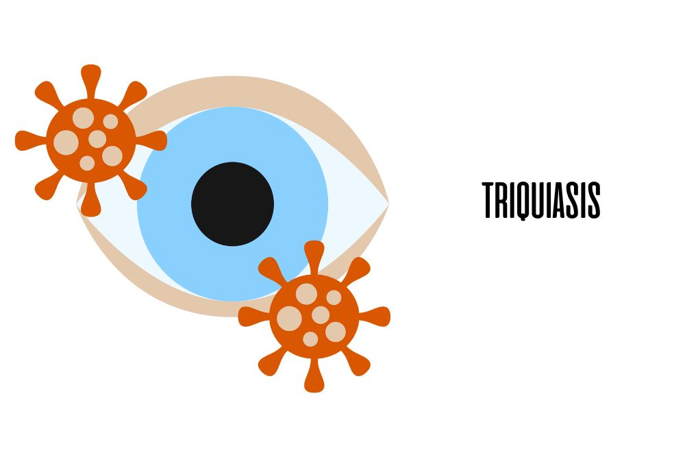 Triquiasis / Ojopedia