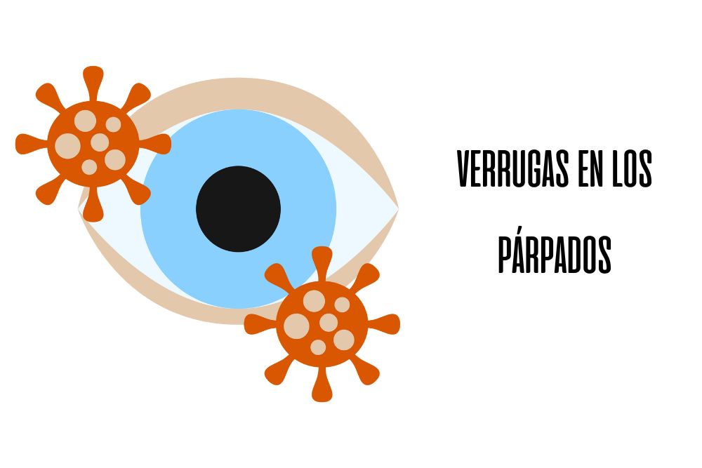 Verrugas en los párpados / Ojopedia