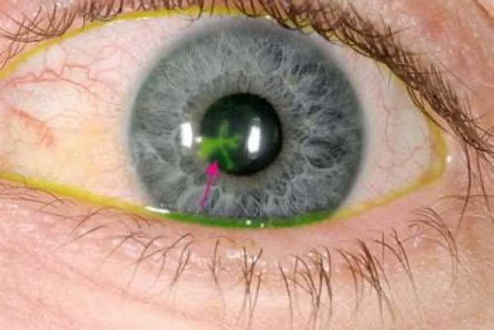 Herpes en el ojo