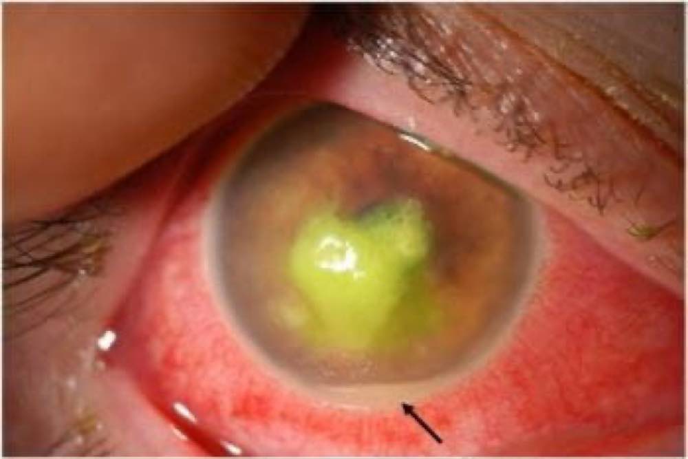 Queratitis bacteriana