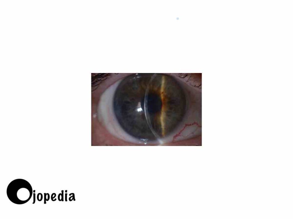 Imagen de un edema de córnea 1