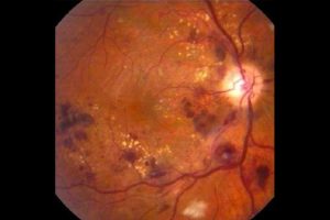 Grados de la retinopatía diabética