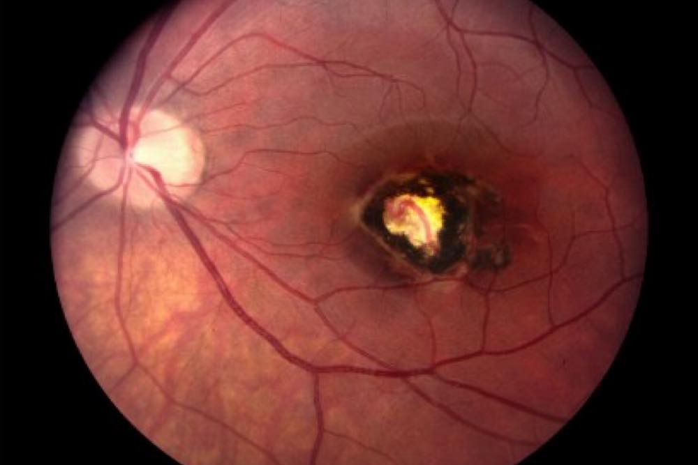 Toxoplasmosis ocular