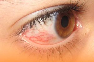 Epiescleritis: Causas, síntomas y tratamiento de esta inflamación ocular