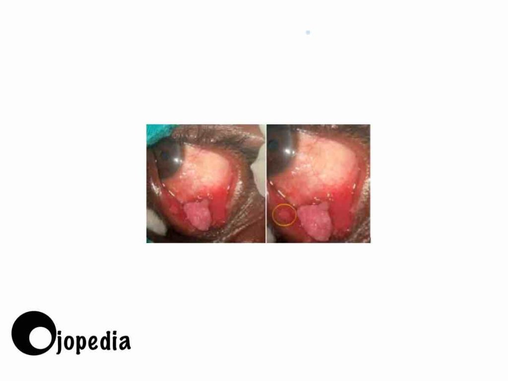 imagen del papiloma conjuntival