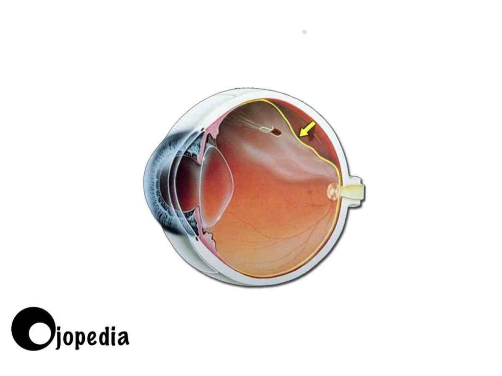 Dibujo de desprendimiento de retina