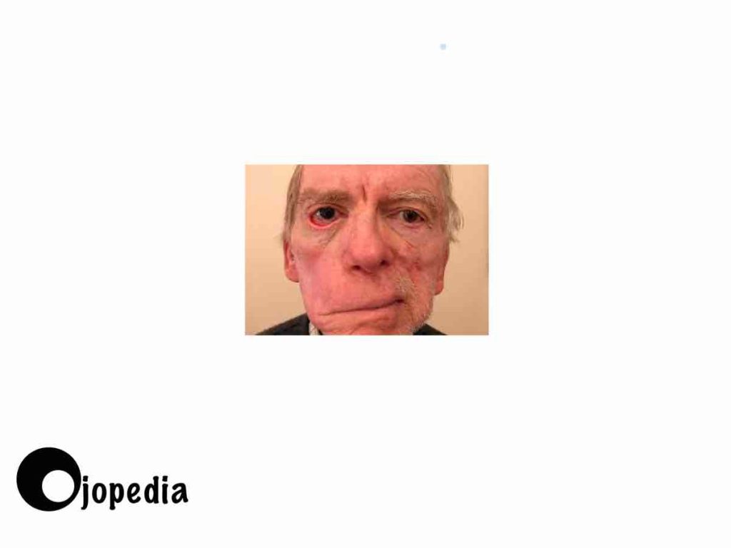 Imagen de parálisis facial