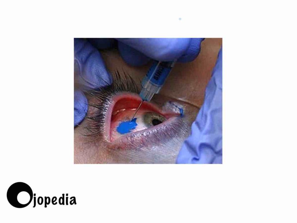 Imagen de tatuaje escleral