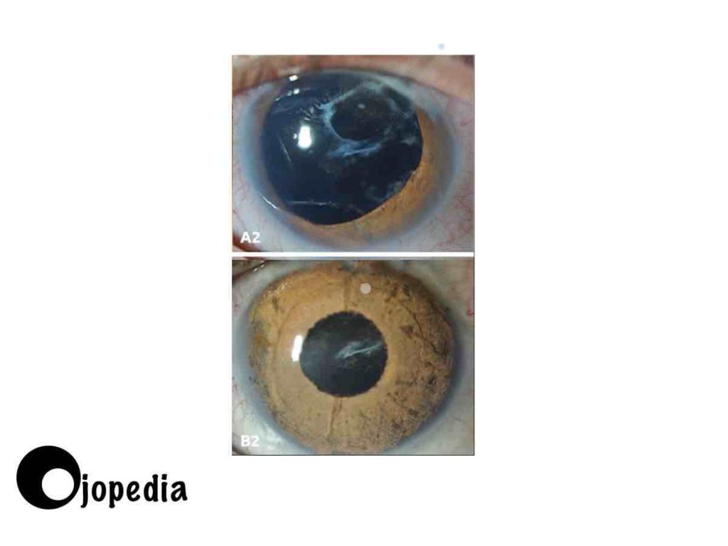 Imagen de tatuaje corneal