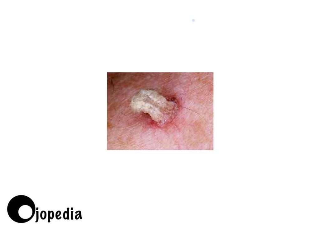 Imagen de la enfermedad de cuerno cutáneo