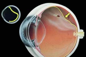 ¿Qué cuidados debe tener una persona con desprendimiento de retina?
