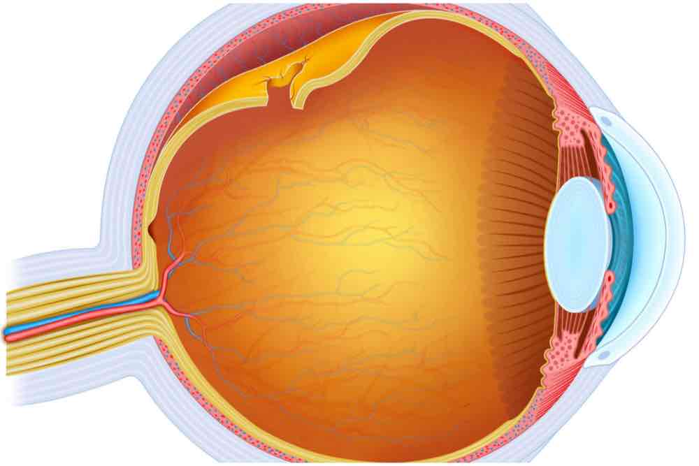 Dibujo de desprendimiento de retina 1