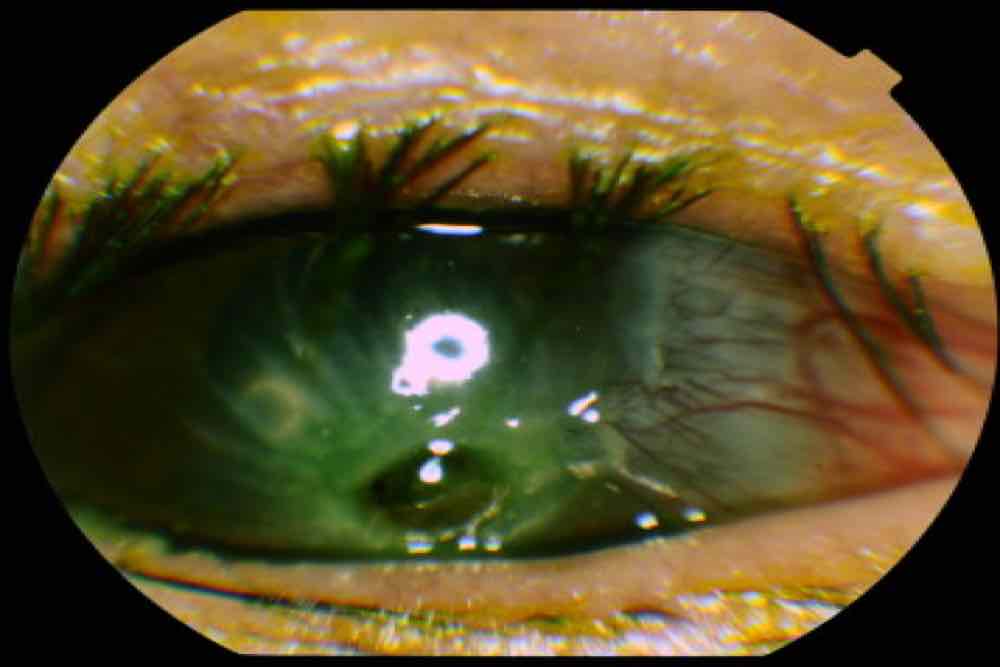 Perforacion corneal 2