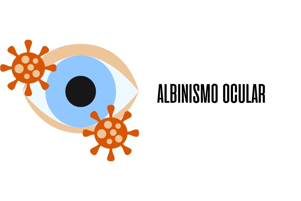 Albinismo ocular / Ojopedia