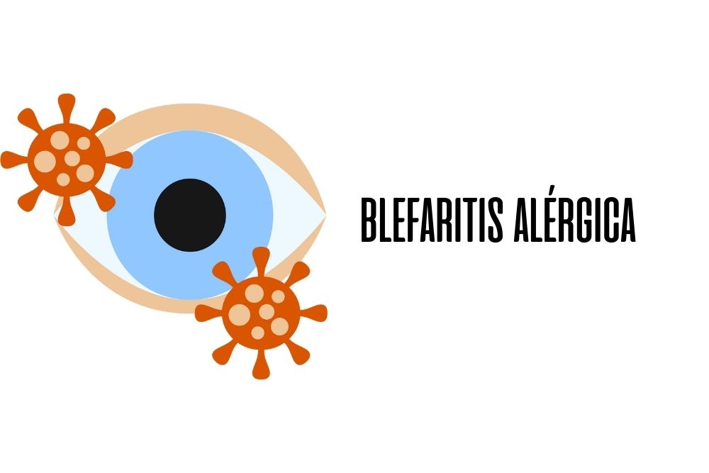 Blefaritis alérgica / Ojopedia