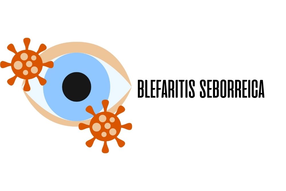 Blefaritis seborreica / Ojopedia