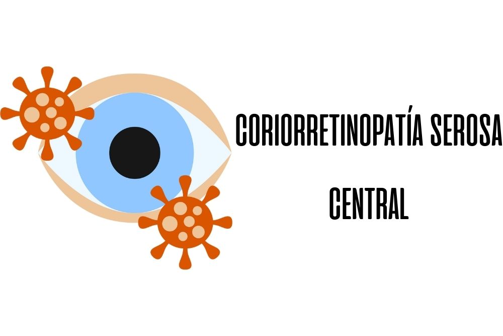 Coriorretinopatía serosa central / Ojopedia