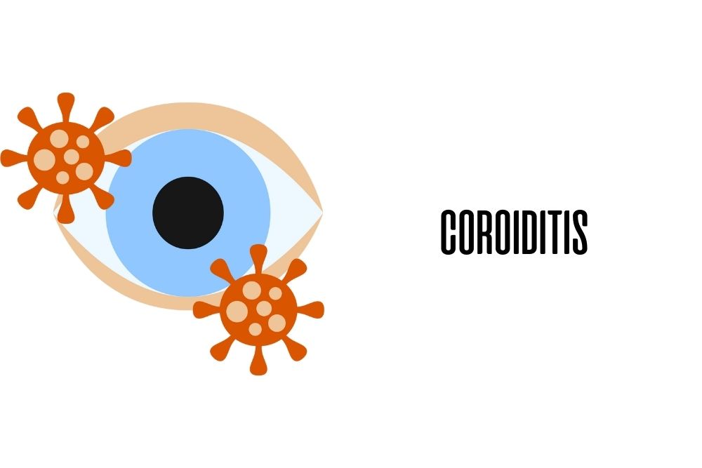 Coroiditis / Ojopedia