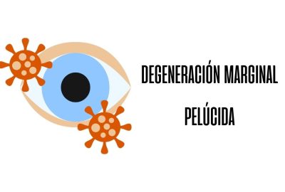 Degeneración marginal pelúcida / Ojopedia