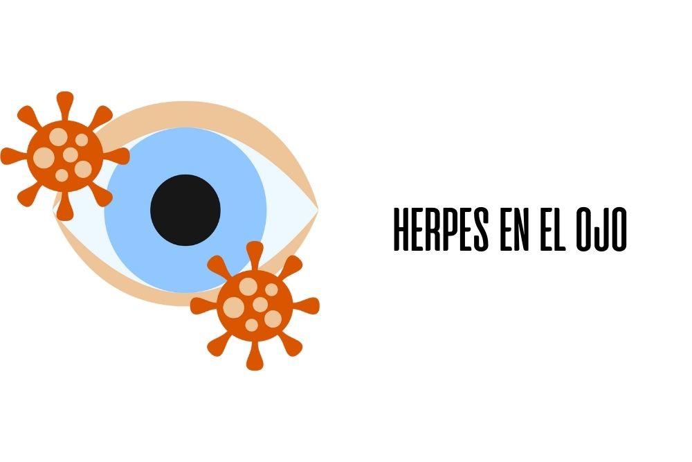 Herpes en el ojo / Ojopedia