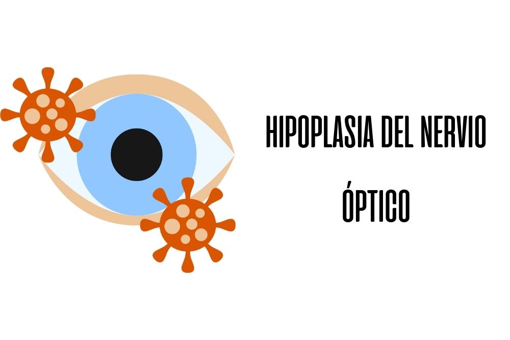 Hipoplasia del nervio óptico / Ojopedia