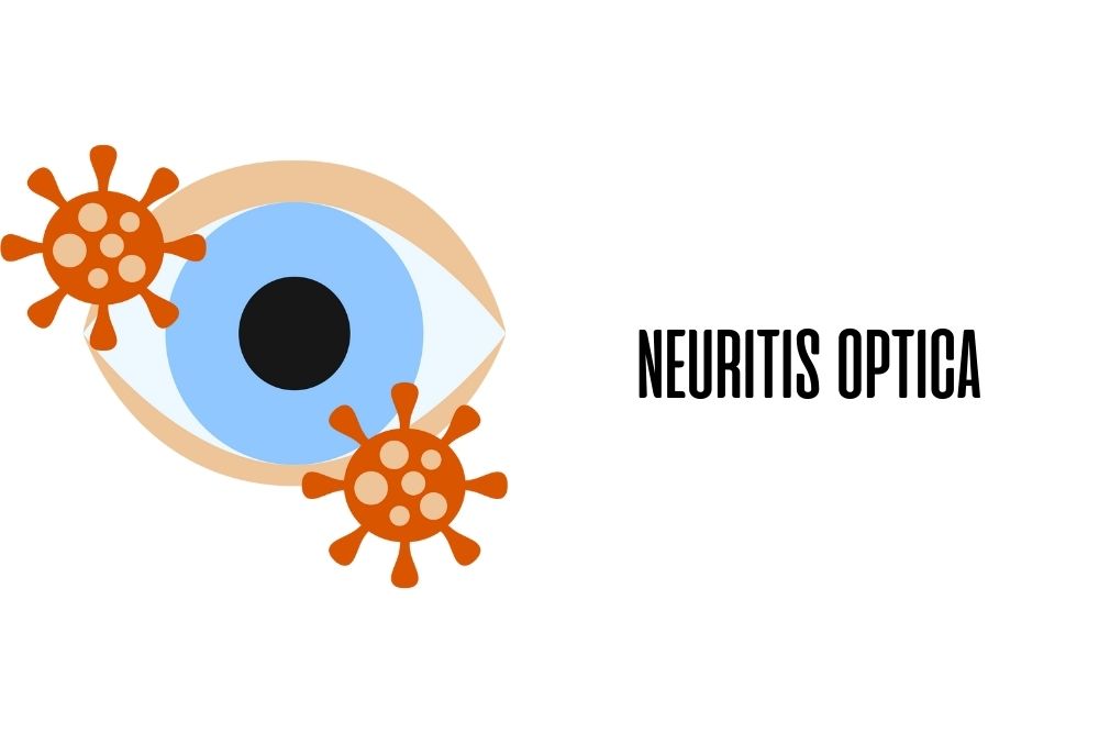 Neuritis optica / Ojopedia