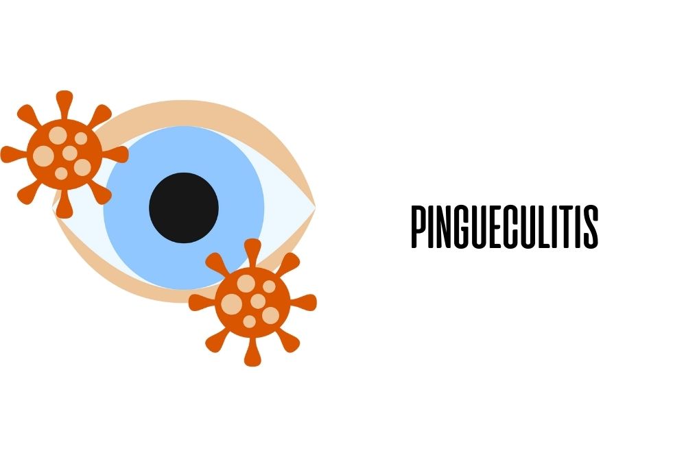 Pingueculitis / Ojopedia