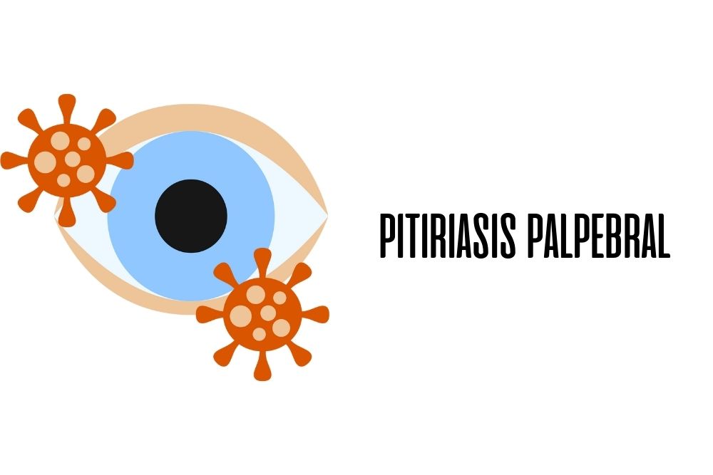 Pitiriasis palpebral / Ojopedia