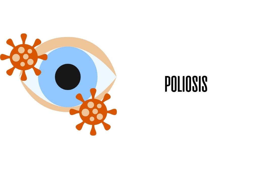 Poliosis / Ojopedia