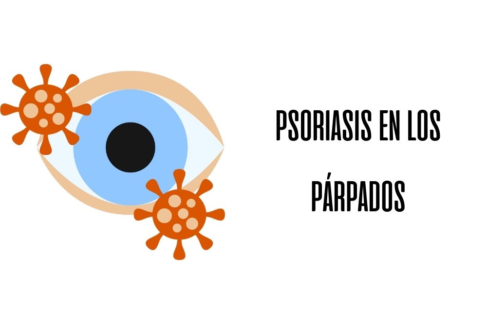 Psoriasis en los párpados / Ojopedia