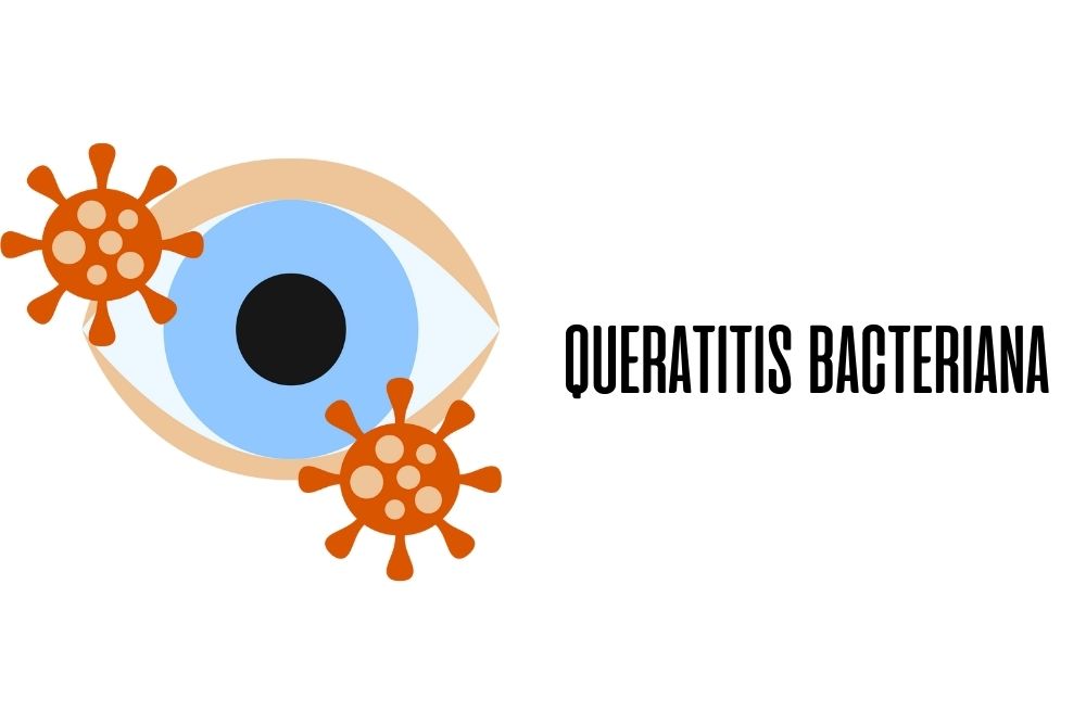 Queratitis bacteriana / Ojopedia
